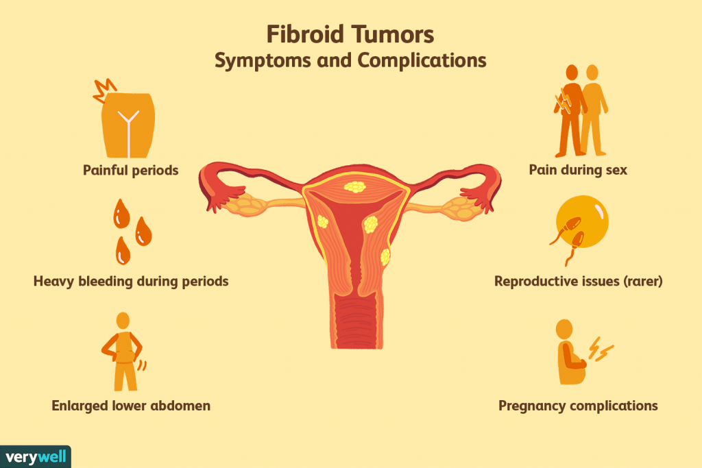 Fibroid - Simptom Fibroid