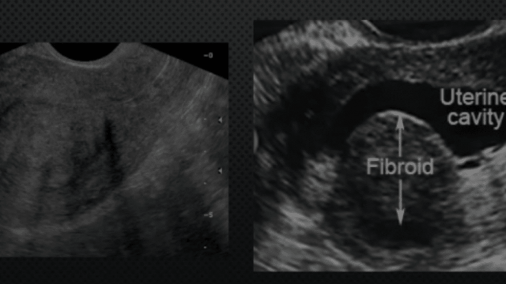 Fibroid - Ultrasound