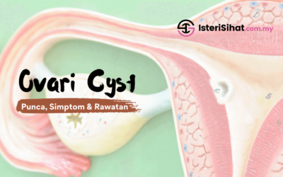 Ovari Cyst – Punca, Simptom dan Rawatan