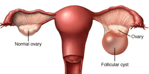 Ovari Cyst