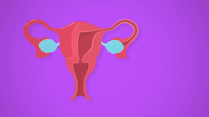 Ovari Cyst