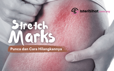 Stretch Mark – Punca dan Cara Hilangkannya